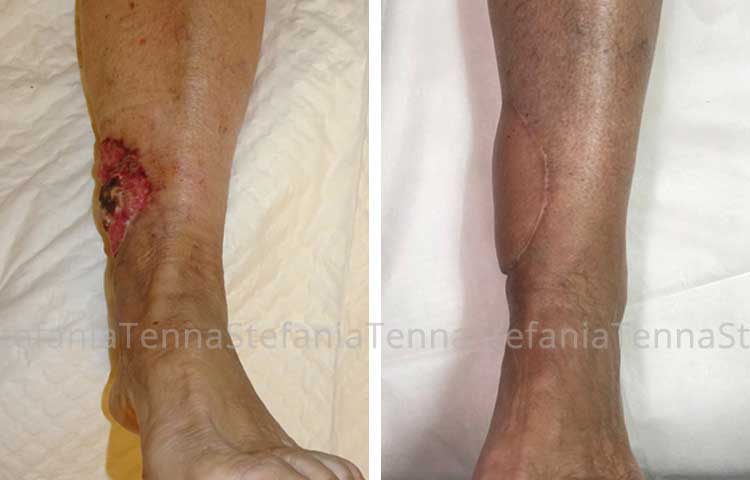 carcinoma gamba ricostruzione lembo microchirurgico